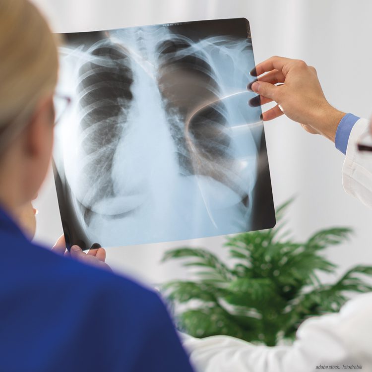 zwei Personen in Krankenhausarbeitskleidung betrachten ein Röntgenbild der mesnschlichen Lunge